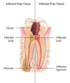 Split diagram of a tooth comparing infected pulp tissue and inflamed pulp tissue, showing decay, abscess, infected or inflamed pulp, and surrounding ligament.