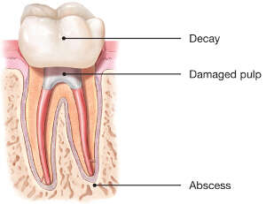 Diagram of a tooth cross-section showing decay on the crown, damaged pulp inside the tooth, and an abscess at the root tip in the jawbone.
