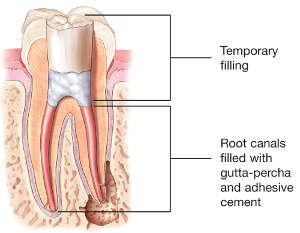 Illustration of a tooth after root canal treatment showing the cleaned and filled root canals inside the tooth’s roots.