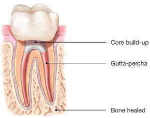 Illustration of a tooth with healed tissues after root canal treatment, showing healthy bone and gum around the treated root.