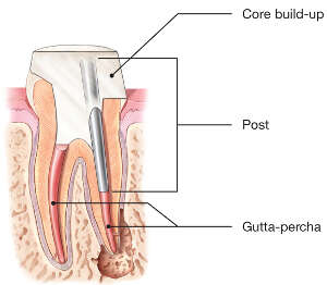 Illustration of a tooth after root canal treatment showing a post placed inside the cleaned root canal and the tooth restored above it.